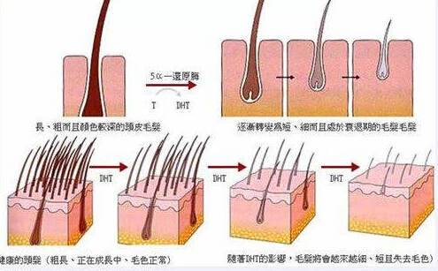 为什么你会得脂溢性脱发，看了之后恍然大悟！