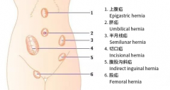 一咳嗽就腹痛且有鼓包，应小心是小肠气在作怪!