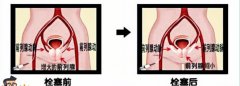 川蜀血管外科专家介绍：血管外科为什么能治疗前列腺增生