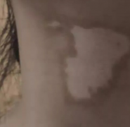 希格玛SQLED308白癜风光疗仪科普：患上了白癜风我们应该